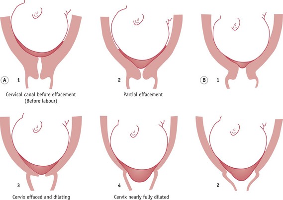 Abnormal uterine action - New