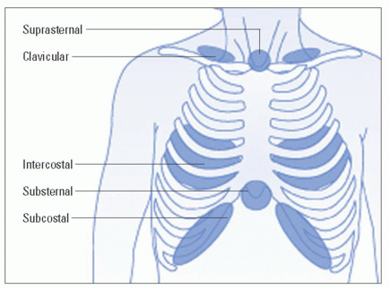 define three types of adventitious breath sounds