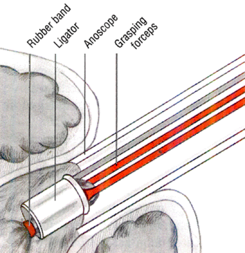 Hemorrhoidectomy | Nurse Key