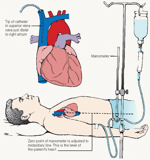 pressure-transducers-and-arterial-line-waveforms-rk-md