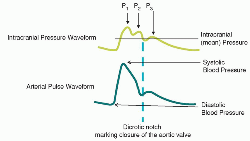 Intracranial Pressure Waveform