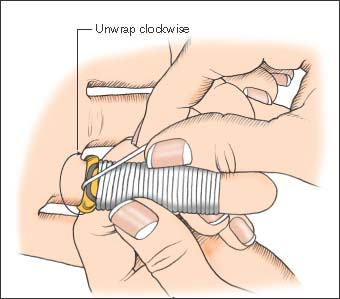 The String Ring Removal Trick — From New to ICU