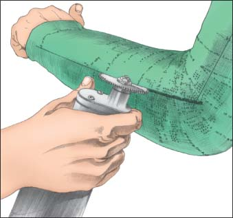 Cast Removal Nurse Key