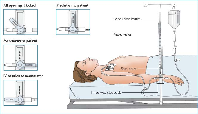 Central Venous Pressure Monitoring Nurse Key