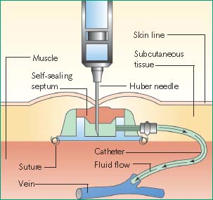 Tube for intravenous fluids injections to implantable port for