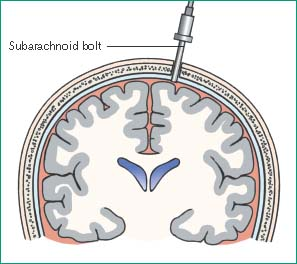 Intracranial Pressure Monitoring Nurse Key