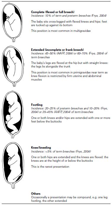 breech presentation management