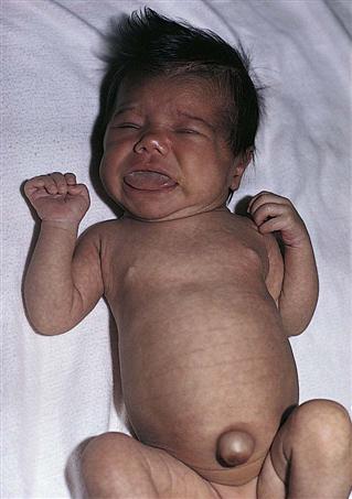 Image result for hypothyroidism AND newborn