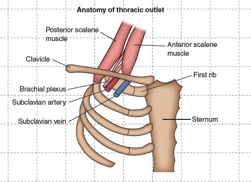 thoracic outlet syndrome surgery pictures