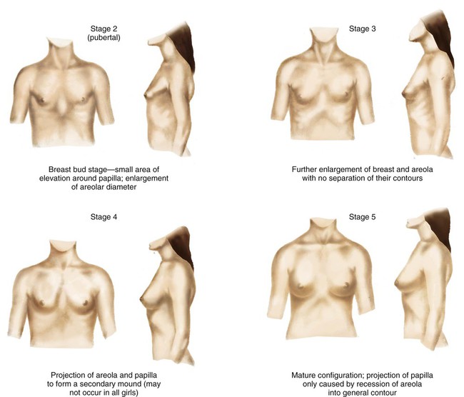 nude stages of puberty growth Tanner Stages of Sexual Development - Pediatrics - Medbullets Step 2/3