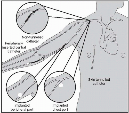 groshong catheter tip