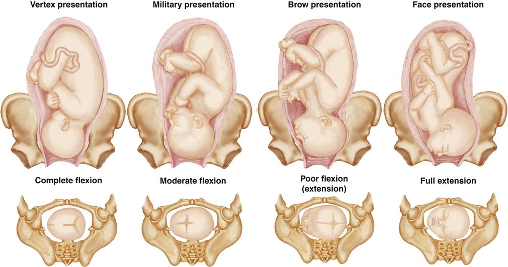 types of presentation of the baby