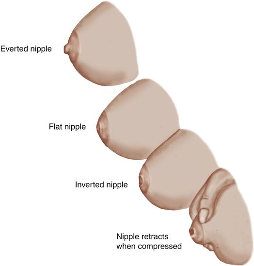 Simple Wishes - Nipples come in many different shapes and sizes. Whether  small, short, flat, inverted, long, wide, average, or everted, when it  comes to breastfeeding, most babies adapt to whatever shape