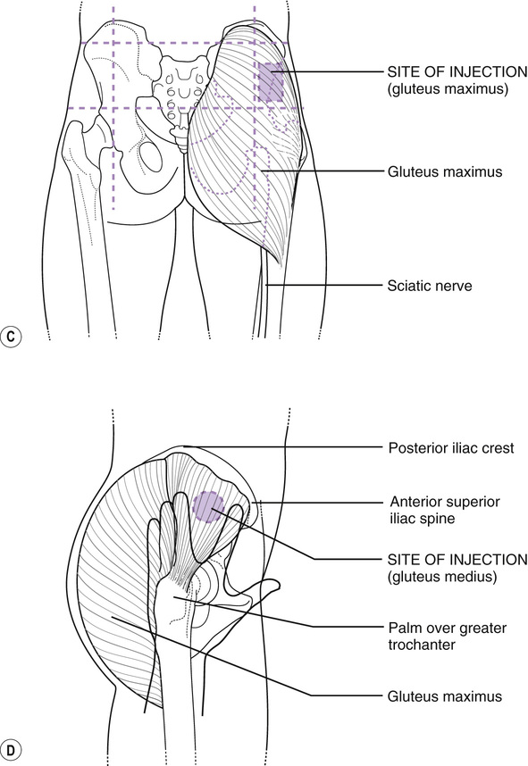 Principles Of Drug Administration Injection Technique Nurse Key 6830