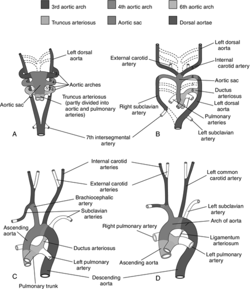 interrupted aortic arch type c collateral vessels
