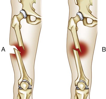 comminuted open fracture images