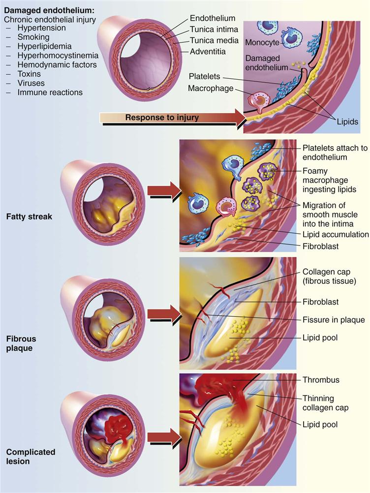 Introduction to Coronary Artery Disease (Ischemic Heart 