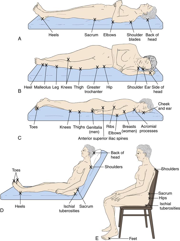 Pressure Ulcer Management