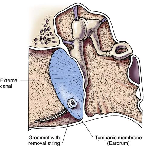 Care of Patients with Ear and Hearing Problems | Nurse Key