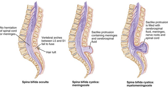 Спина бифида: симптомы, причины, лечение и операция, осложнения, фонд помощи
