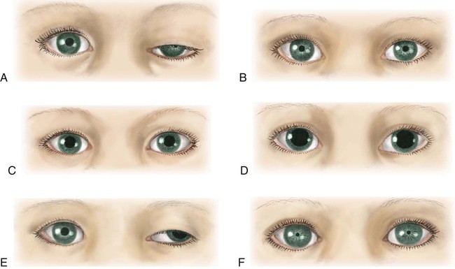 ipsilateral pupil dilation