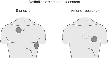 placement anterior posterior defibrillation electrode cardiovascular emergencies figure
