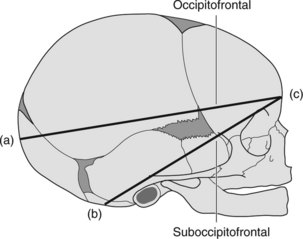 occipital contour definition