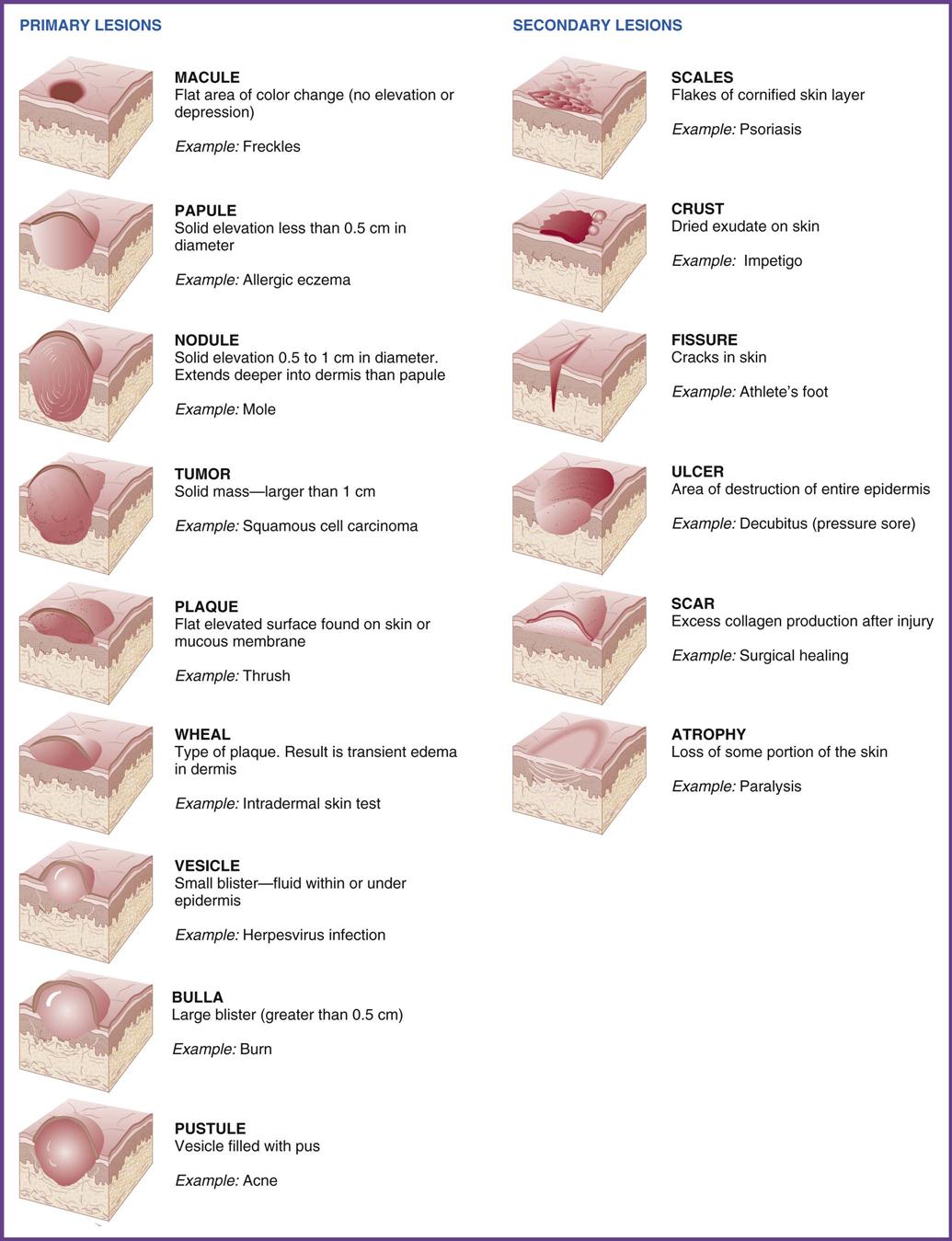 Types Of Skin Lesions Chart