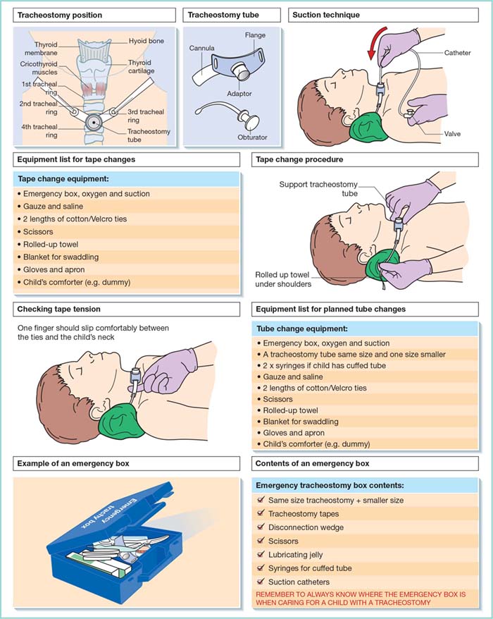 Tracheostomy Care | Nurse Key