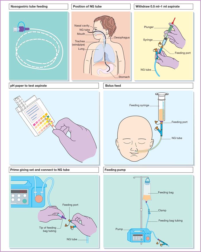 Enteral Tube Feeding Procedure