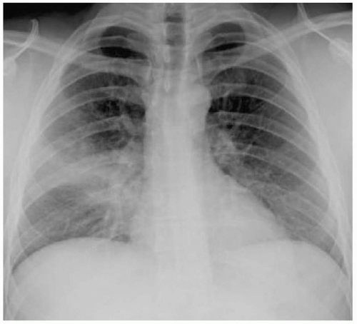 Radiologic Examination Of The Chest | Nurse Key